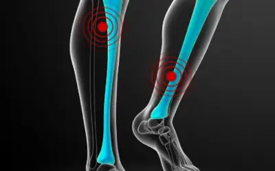 What to do about shin splints.
